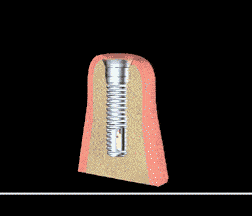 Dental implants are metal anchors that act as tooth root substitutes, Sugar Land TX