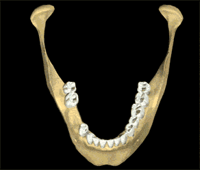Bone Grafting, Houston TX