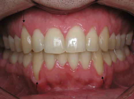 Before Gam Grafting Procedure, Houston TX