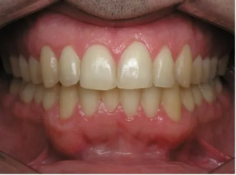 After Gam Grafting Procedure, Houston TX