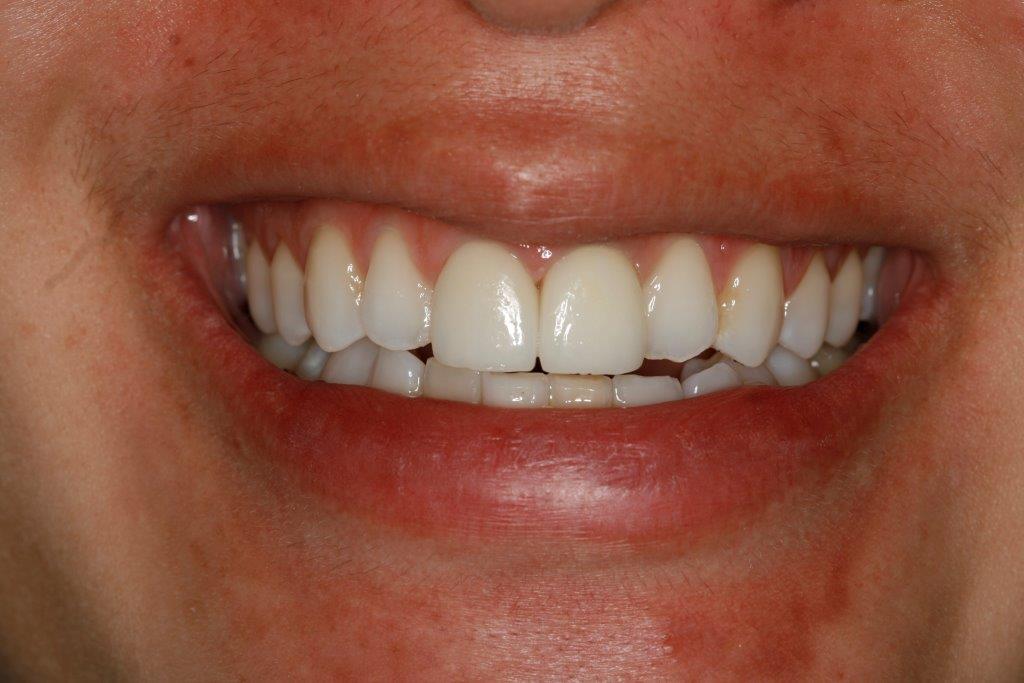 Dental Implants Photo Gallery Sugar Land TX, Implants Houston TX