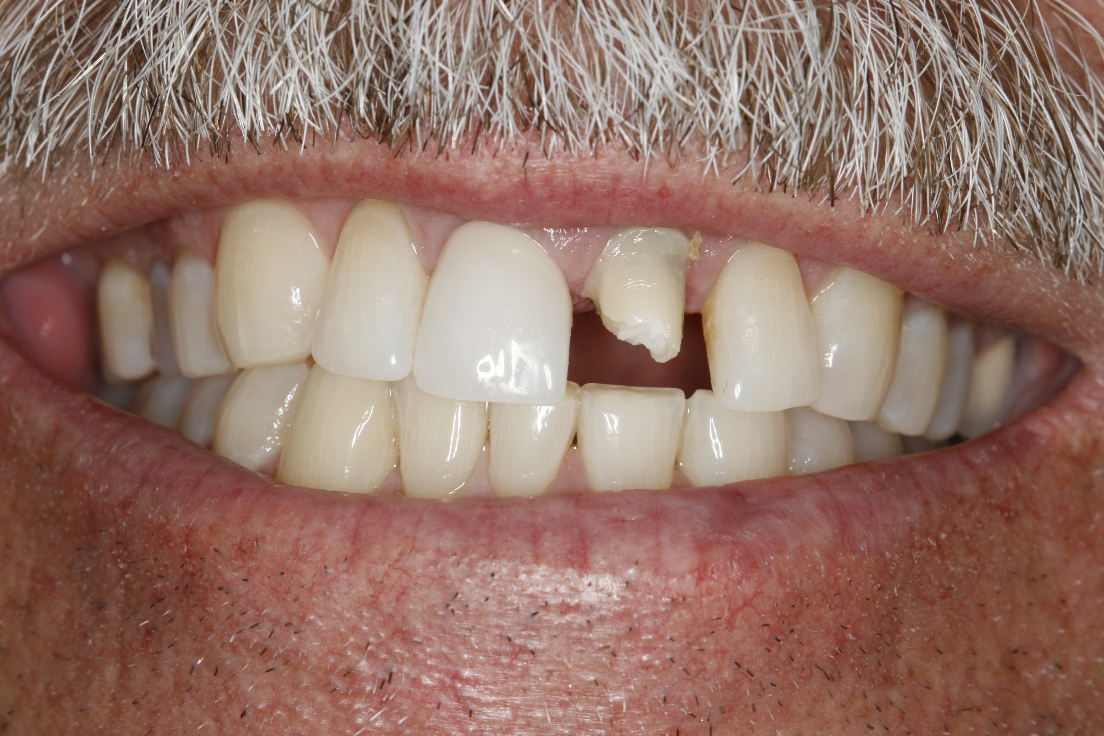 Dental Implants Photo Gallery Sugar Land TX, Implants Houston TX