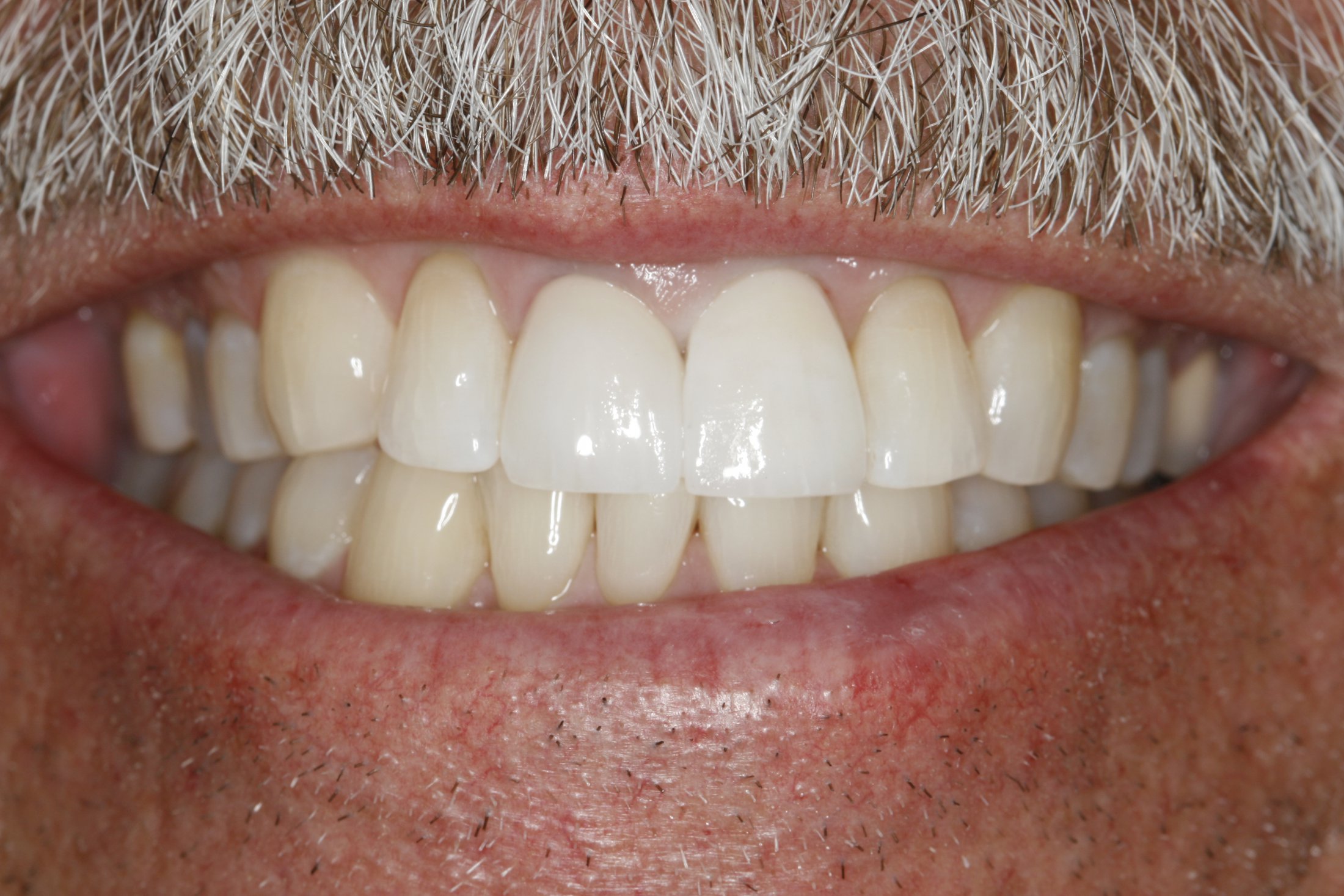 Dental Implants Photo Gallery Sugar Land TX, Implants Houston TX