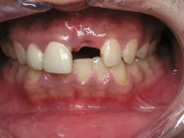 Photo of teeth before dental impant placement #3, Houston TX