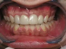 Photo of teeth after dental impant placement #3, Houston TX