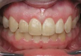 Dental photo made after Cosmetic Periodontal Surgery, Houston TX