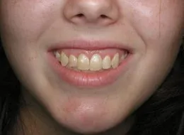 Facial photo made after Cosmetic Periodontal Surgery, Houston TX