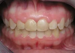 Dental photo made before Cosmetic Periodontal Surgery, Houston TX