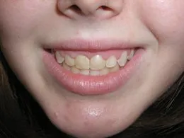 Facial photo made before Cosmetic Periodontal Surgery, Houston TX