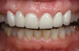 Photo made after Cosmetic Periodontal Surgery, Sugar Land TX