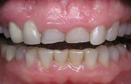 Photo made before Cosmetic Periodontal Surgery, Sugar Land TX