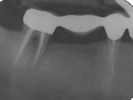 X-ray of mouth before dental impant placement #2, Sugar Land TX