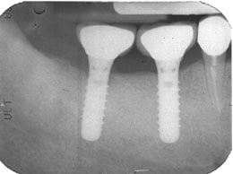 X-ray of mouth after dental impant placement #2, Sugar Land TX