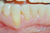 Before subepithelial connective tissue grafts, Houston TX