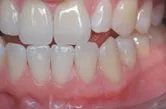 After subepithelial connective tissue grafts, Sugar Land TX