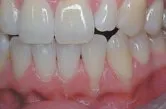 Before subepithelial connective tissue grafts, Sugar Land TX