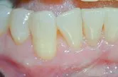 After subepithelial connective tissue grafts, Houston TX