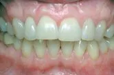 After subepithelial connective tissue grafts, Dr. Watson, Periodontist