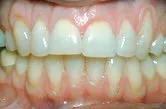 Before subepithelial connective tissue grafts, Dr. Watson, Periodontist