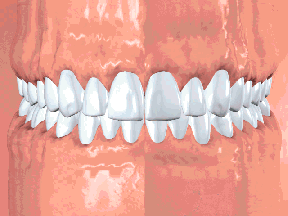 Animation about Periodontal Disease, Houston & Sugar Land TX<
