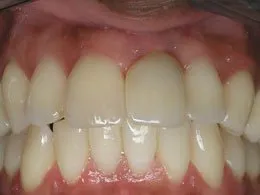 Photo of teeth after dental impant placement, Houston TX