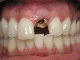 Photo of teeth before dental impant placement, Houston TX