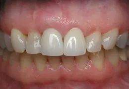 Photo made after Combination Crown Lengthening/Root Coverage Grafting, Houston TX