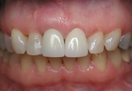 Photo made after Combination Crown Lengthening/Root Coverage Grafting, Houston TX