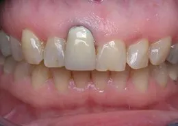 Photo made before Combination Crown Lengthening/Root Coverage Grafting, Houston TX