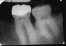 X-ray of Guided Tissue Bone Regeneration, Houston & Sugar Land TX