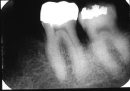 Additional X-ray of Guided Tissue Bone Regeneration, Houston & Sugar Land TX