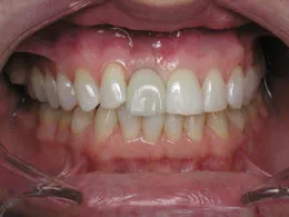 Photo of teeth after dental impant placement #2, Houston TX