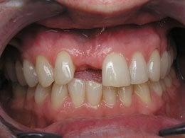 Photo of teeth before dental impant placement #2, Houston TX