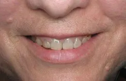 Photo made before Cosmetic Periodontal Surgery, Houston TX