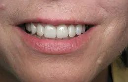 Photo made after Cosmetic Periodontal Surgery, Houston TX