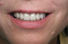 Photo made after Cosmetic Periodontal Surgery, Houston TX