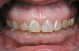 Photo of teeth made before Cosmetic Periodontal Surgery, Houston TX