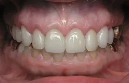 Photo of teeth made after Cosmetic Periodontal Surgery, Houston TX