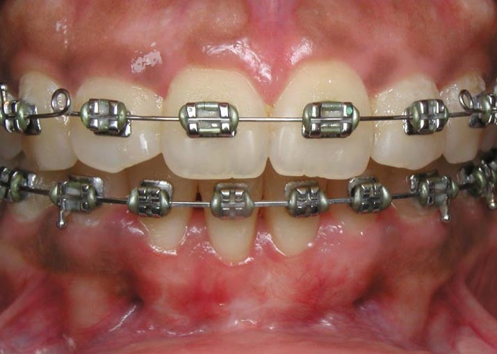 After subepithelial connective tissue grafts example, Dr. Watson, Periodontist