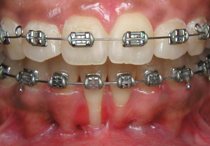Before subepithelial connective tissue grafts example, Dr. Watson, Periodontist