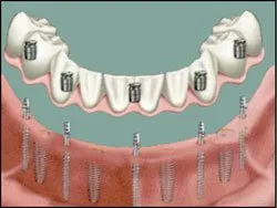 Mini Traditional Dental Implants 1, Houston TX