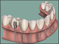 Mini Traditional Dental Implants 2, Houston TX