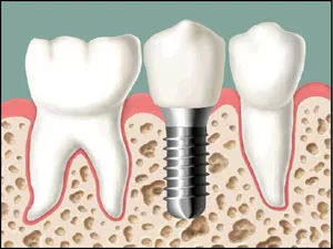 One Stage Dental Implants 1, Houston TX