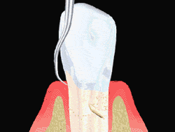 Root Planing animation Smoothing The Tooth Root, Houston TX