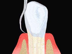 Subgingival Scaling animation, Cleaning The Tooth Below The Gum, Sugar Land TX