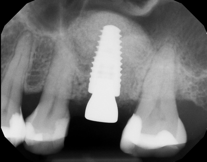 Dental Implants Photo Gallery Sugar Land TX, Implants Houston TX